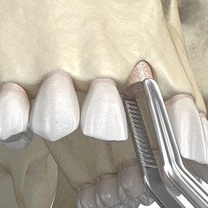 diagram of a bone graft or preliminary procedure