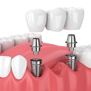 diagram of the parts of dental implants in Keokuk