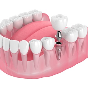 Illustration of a single dental implant