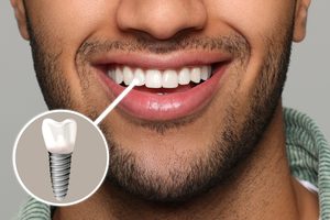 Nose-to-chin view of man smiling with a tooth indicated as an implant