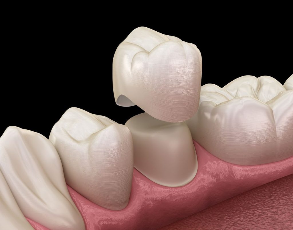 A CGI of a tooth getting a dental crown
